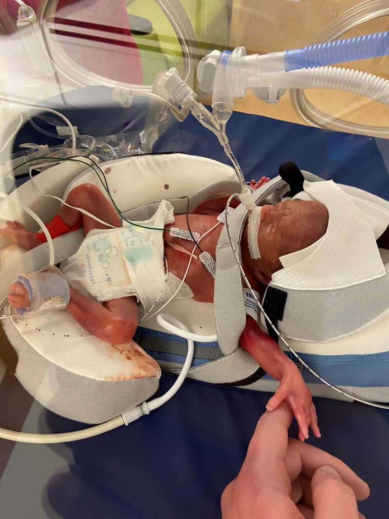 Newborn Jaxson Bruce receiving care in the NICU after his premature birth